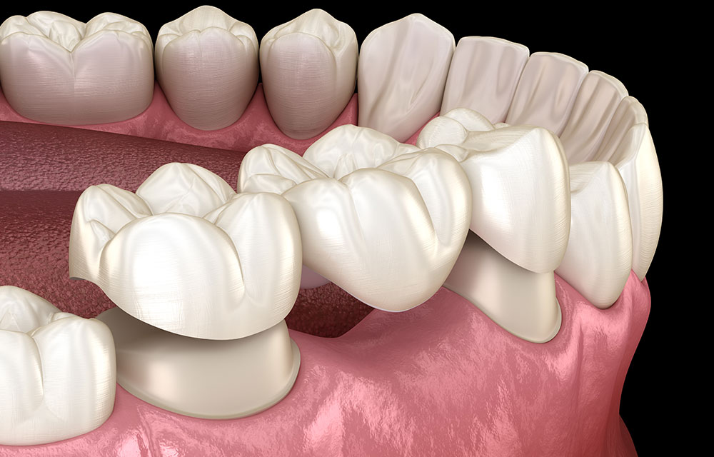 Digital graphic of dental bridge being placed over damaged gumline
