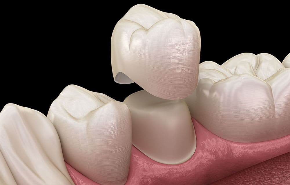 Digital graphic of dental crown being placed on damaged tooth