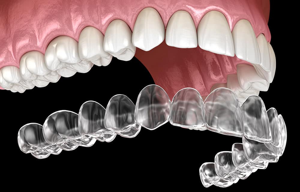 Digital graphic comparing Invisalign aligner to natural teeth