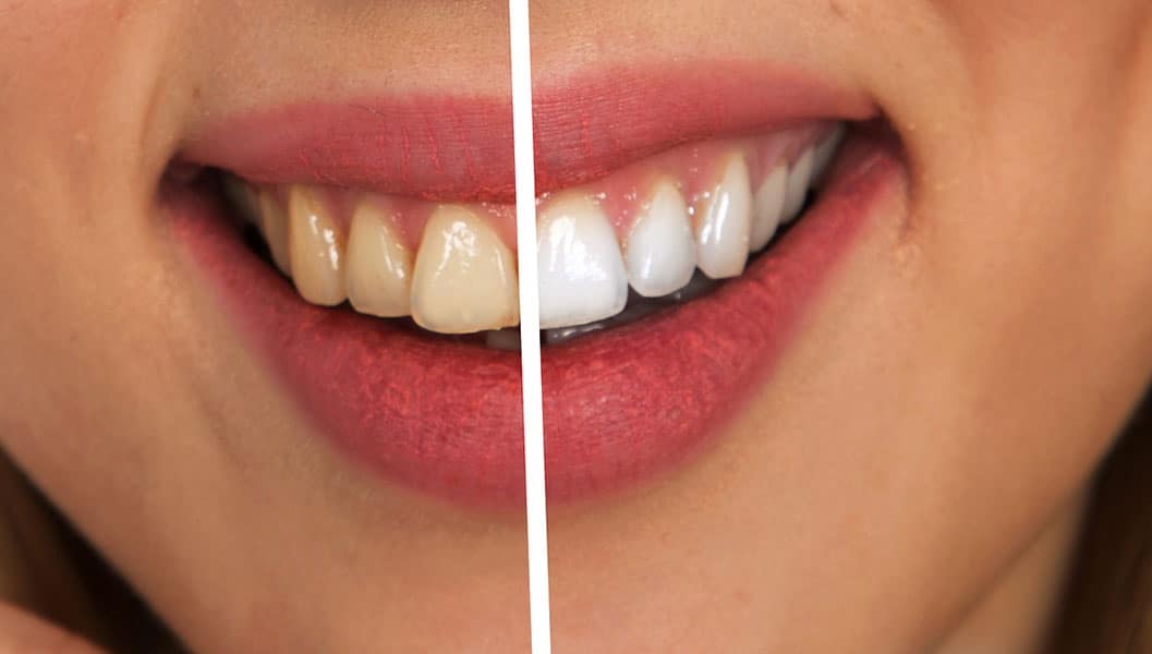 Woman smiling before and after deep teeth cleaning