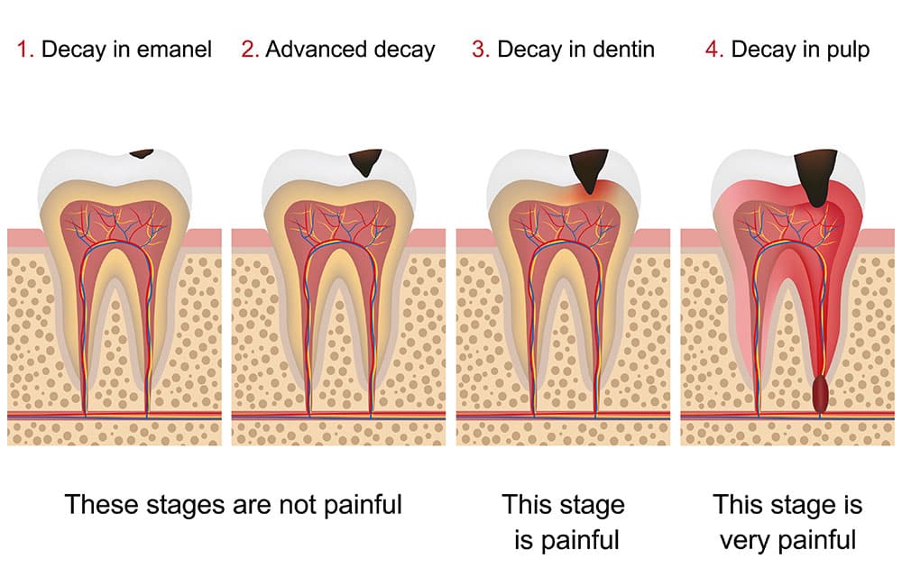 Chart showing stages of dental decay