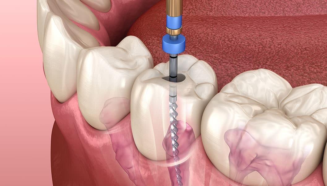 Digital rendering of dental drill during root canal treatment