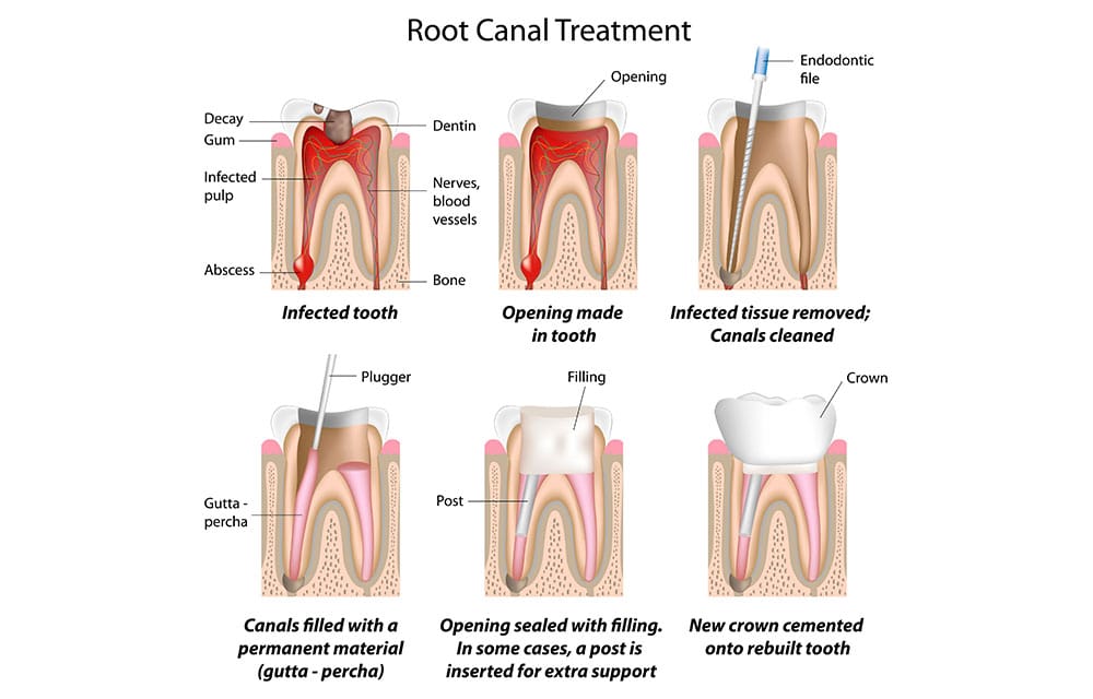 Illustration of the six stages of root canal treatment