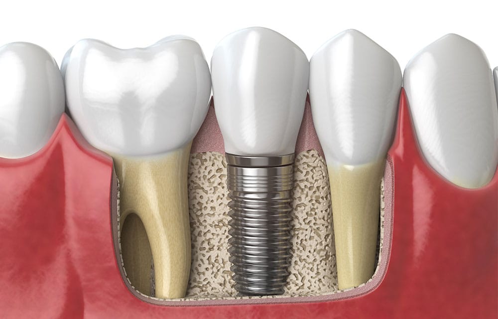 Digital comparison of teeth and dental implant below gumline