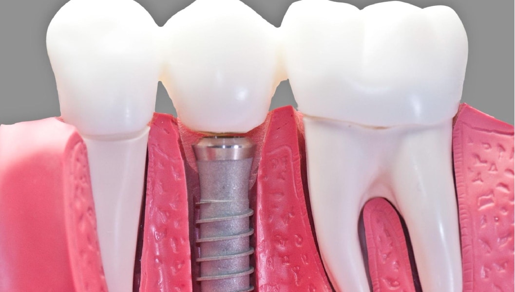 What To Expect During Dental Implant Recovery