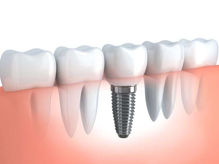 Bone and gums heal quite quickly after placing dental implants; replacement teeth that are long-lasting and natural-looking.