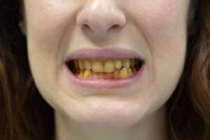 teeth discoloration