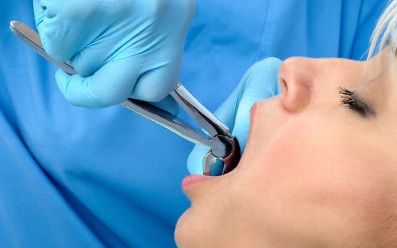 Tooth Extraction Procedure