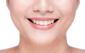 Teeth Whitening Options