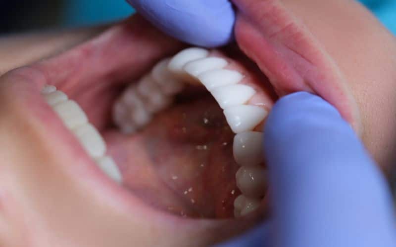 Doctor Dentist Examining Patient Oral Cavity With Veneers Closeup