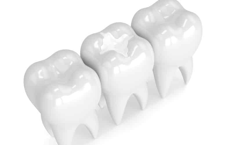 Reduce Tooth Sensitivity