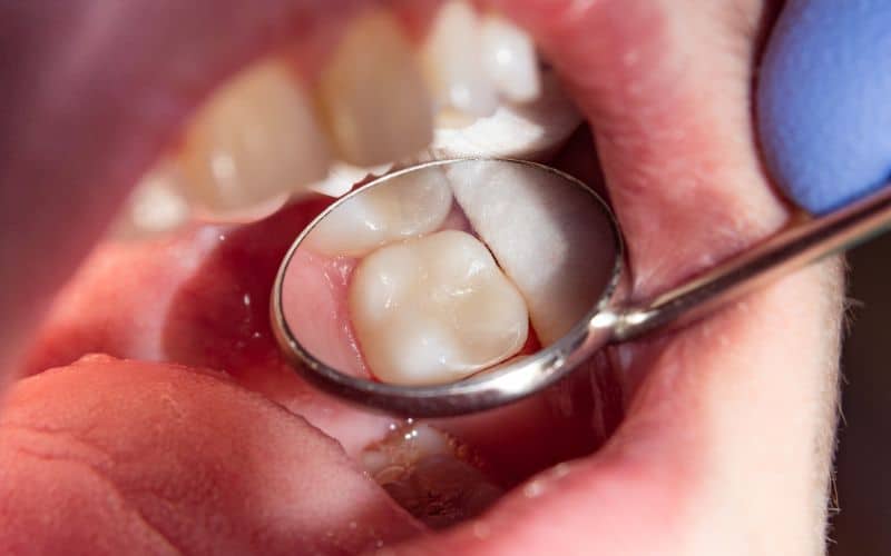 What Are the Benefits of White Fillings?