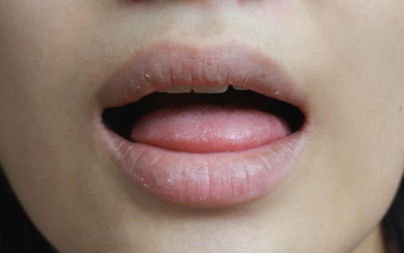 cracked lips caused by dry skin and lack of saliva dry mouth symptoms