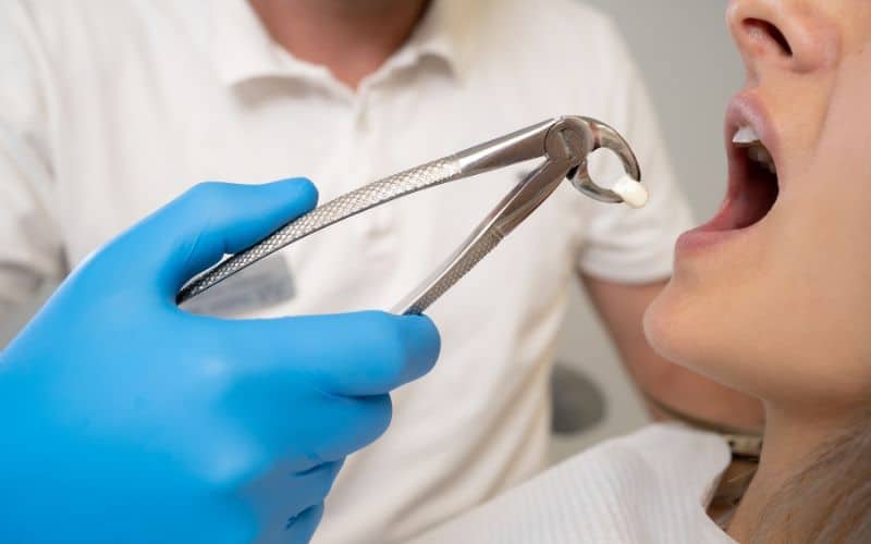 Tooth removal surgery being performed by a dental professional