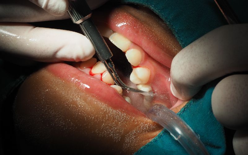 dentists treating gingivitis by scaling