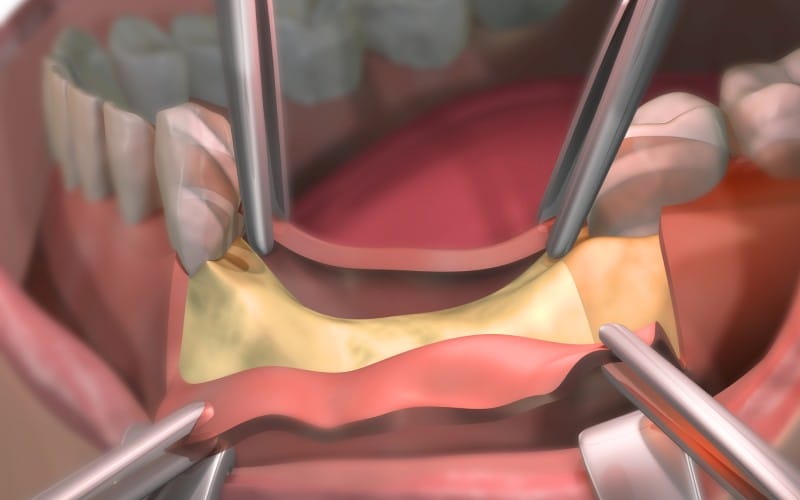 Enhancing Oral Health: The Transformative Power of Dental Bone and Gum Graft Surgery