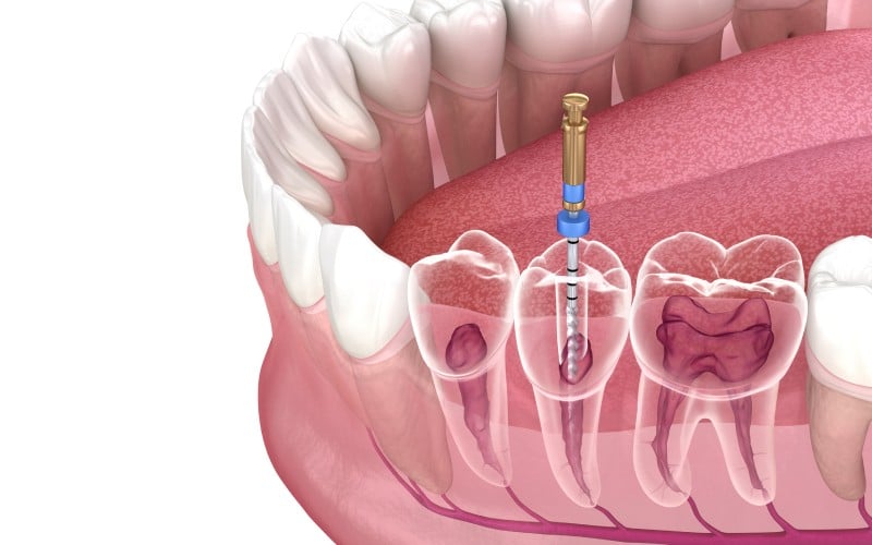 endodontic root canal treatment process medically accurate tooth illustration