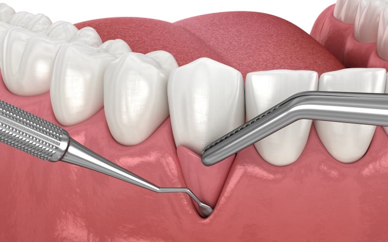 gum-recession-soft-tissue graft surgery illustration dental treatment