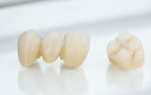 metal free ceramic dental crowns