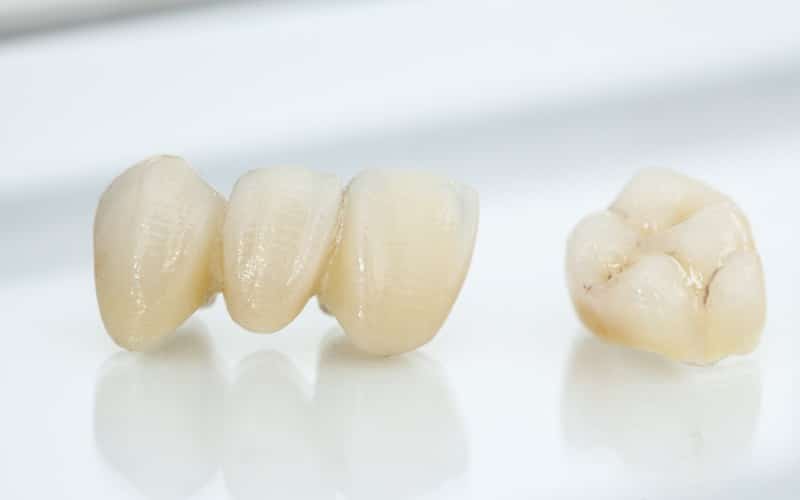 How Dental Crowns Work: Benefits and Maintenance Tips