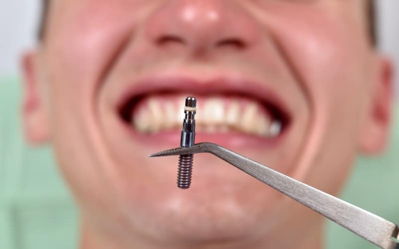 dental implant in tweezers