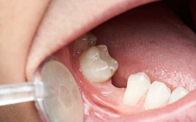 Understanding How Dental Implants Function