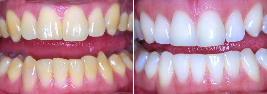 before-after-whitening